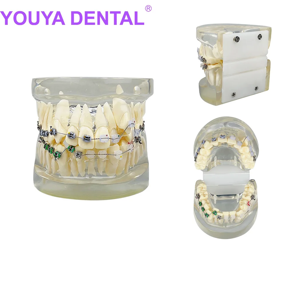 Зъбни зъби Грешна челюст Наполовина метална Половин керамична ортодонтска Модел Стоматологичен модел за зъболекар Студентски преподавателски демонстрационен инструмент Изображение 0