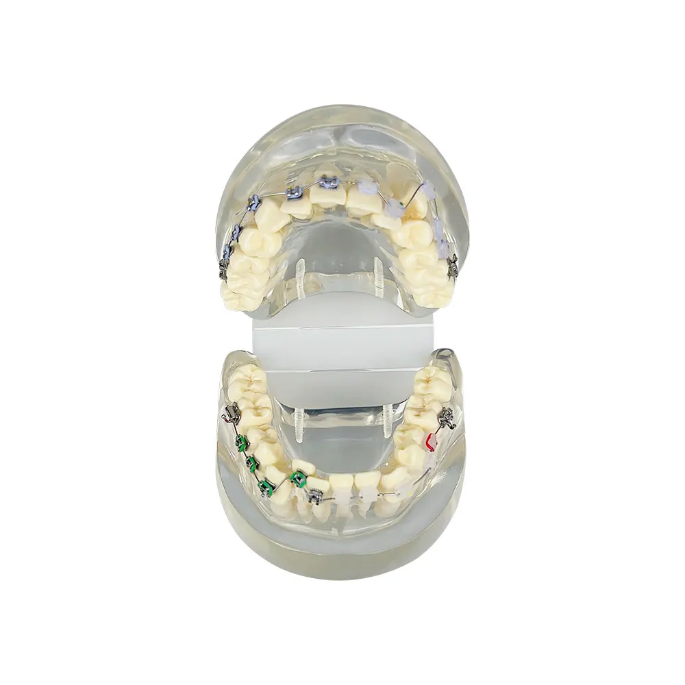 Зъбни зъби Грешна челюст Наполовина метална Половин керамична ортодонтска Модел Стоматологичен модел за зъболекар Студентски преподавателски демонстрационен инструмент Изображение 1